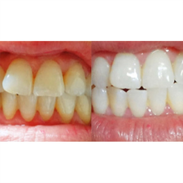 2+1 닥터하이얀 식약처인증 치아미백 화이트닝 기능성 치약 100g