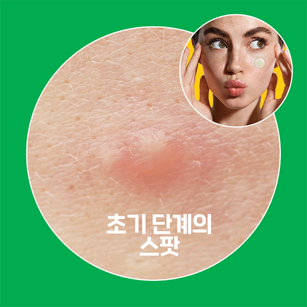 놀라아워 스팟 이레이저 그린 9매(초기 단계 트러블용)