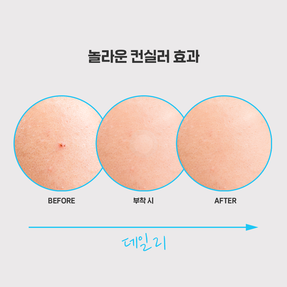 놀라아워 스팟 이레이저 블루 63매(트러블 케어 및 보호용)